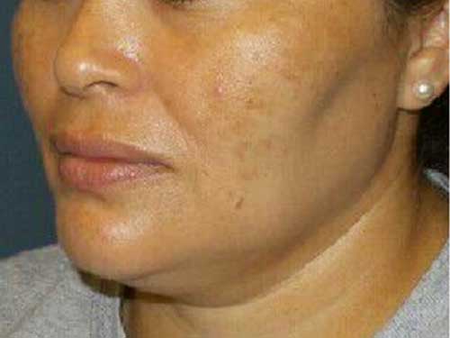 Medical Grade Skincare Patient Before