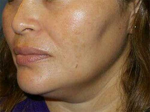 Medical Grade Skincare Patient After