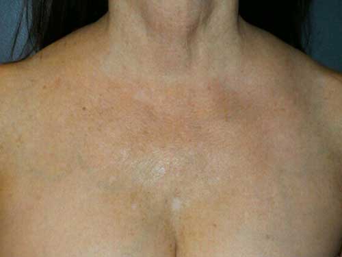 IPL Photo Rejuvenation Patient After