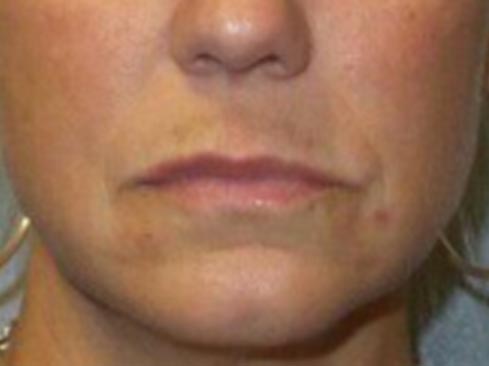 Anti-Aging Treatment Patient Before