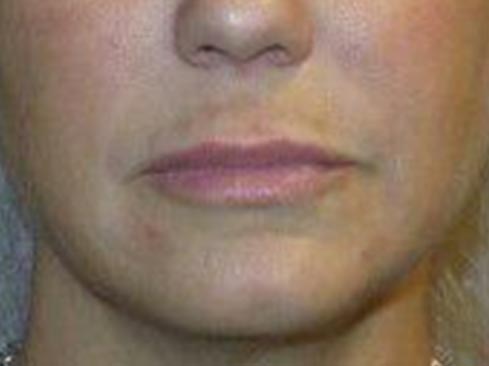 Anti-Aging Treatment Patient After