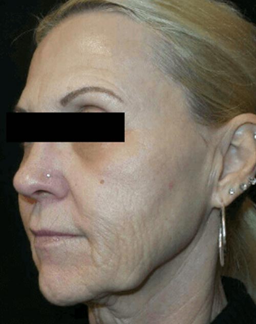 Microneedling Patient Before