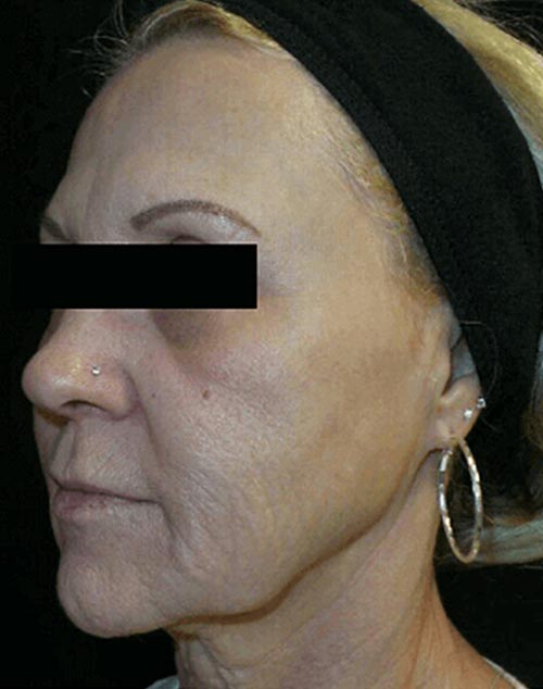 Microneedling Patient After
