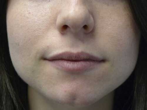 Restylaneยฎ Patient Before