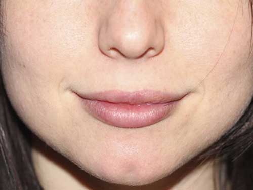 Restylane® Patient After