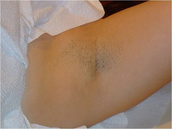 Laser Hair Removal Patient Before