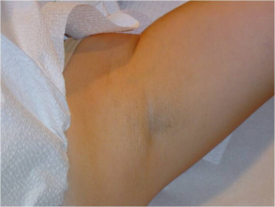 Laser Hair Removal Patient After