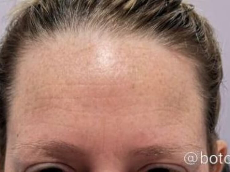 BOTOX® Cosmetic Patient After