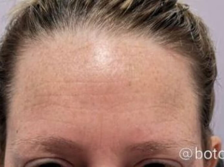 BOTOXยฎ Cosmetic Patient After