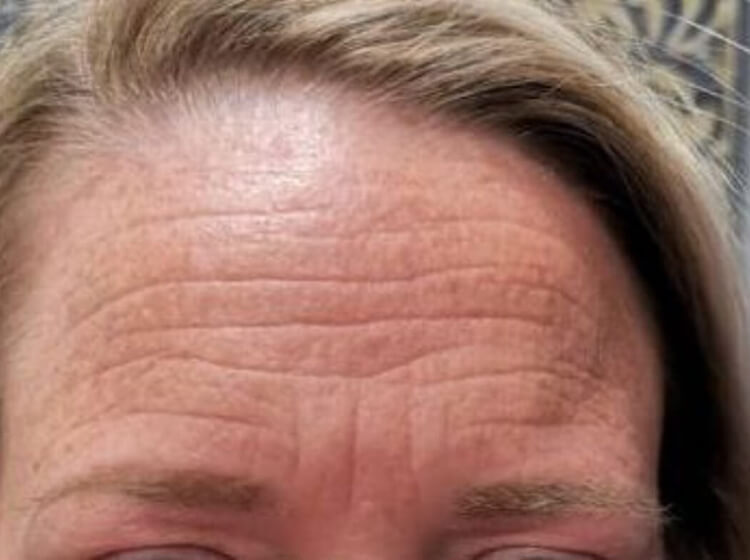 BOTOXยฎ Cosmetic Patient Before