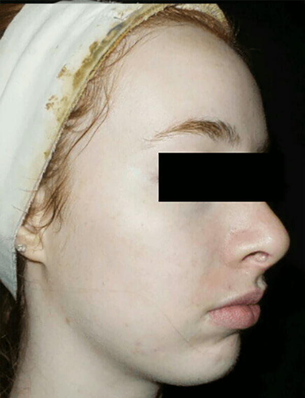 Chemical Peel Patient After