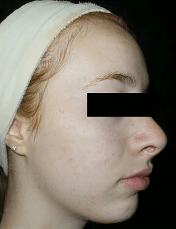 Chemical Peel Patient Before