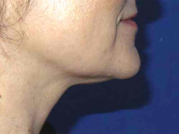 Kybella® Patient After