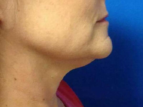 Kybella® Patient Before