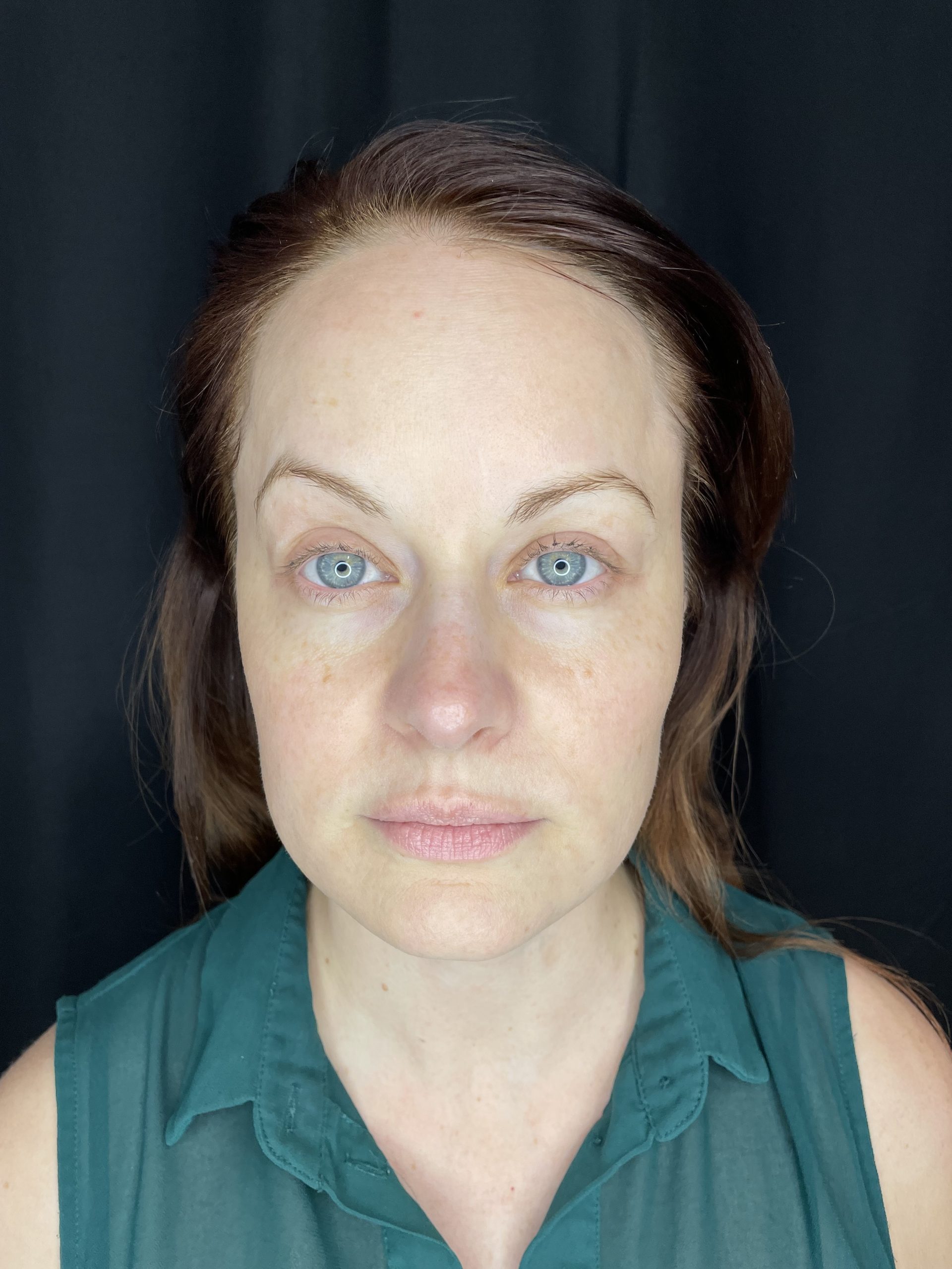 BroadBand Light (BBL) Photo Rejuvenation After Patient 3