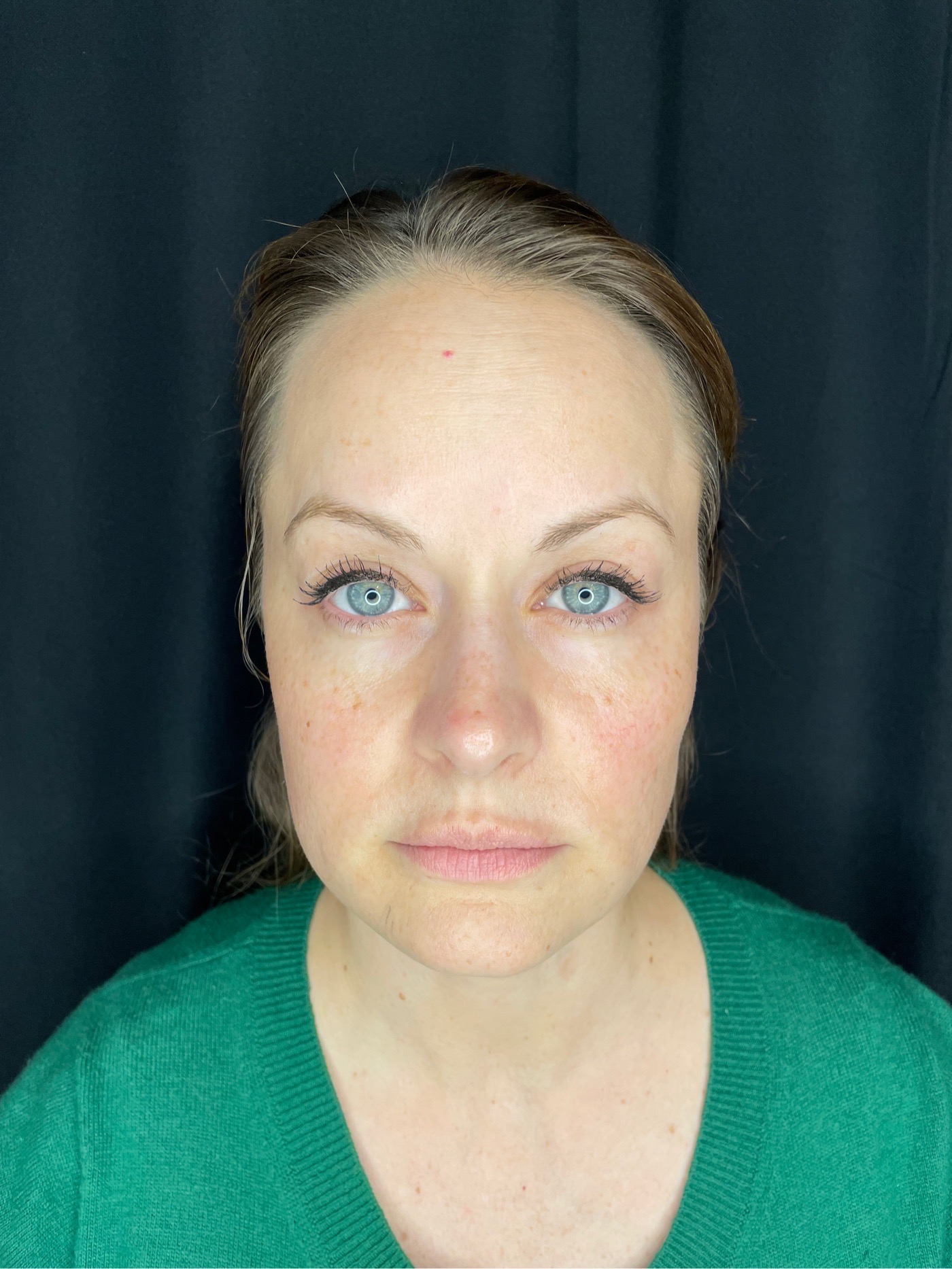 BroadBand Light (BBL) Photo Rejuvenation Before Patient 3