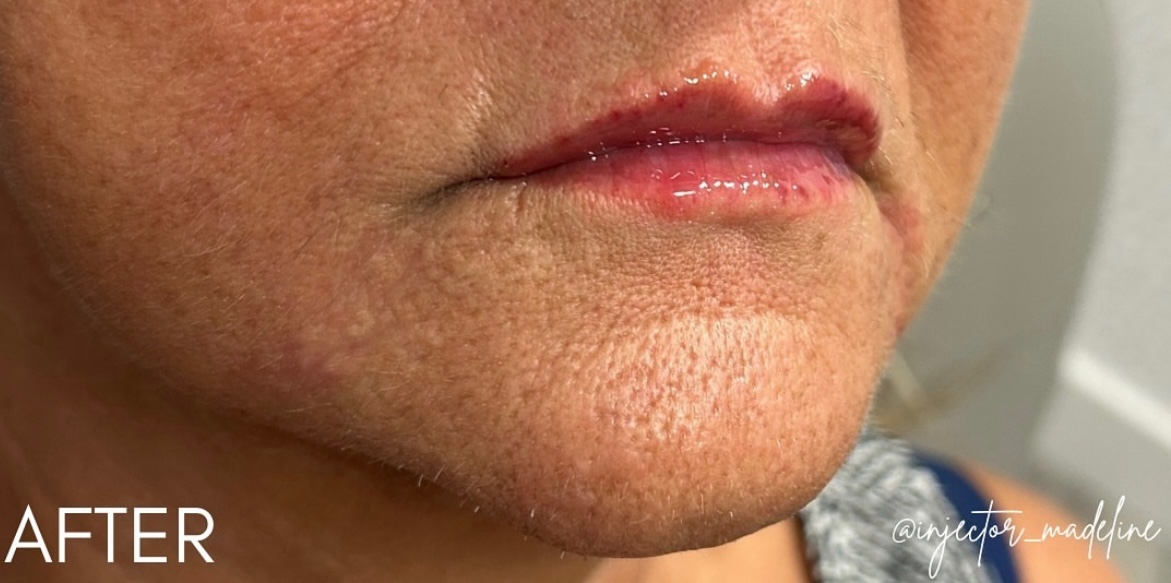 Lip Filler After Patient 6