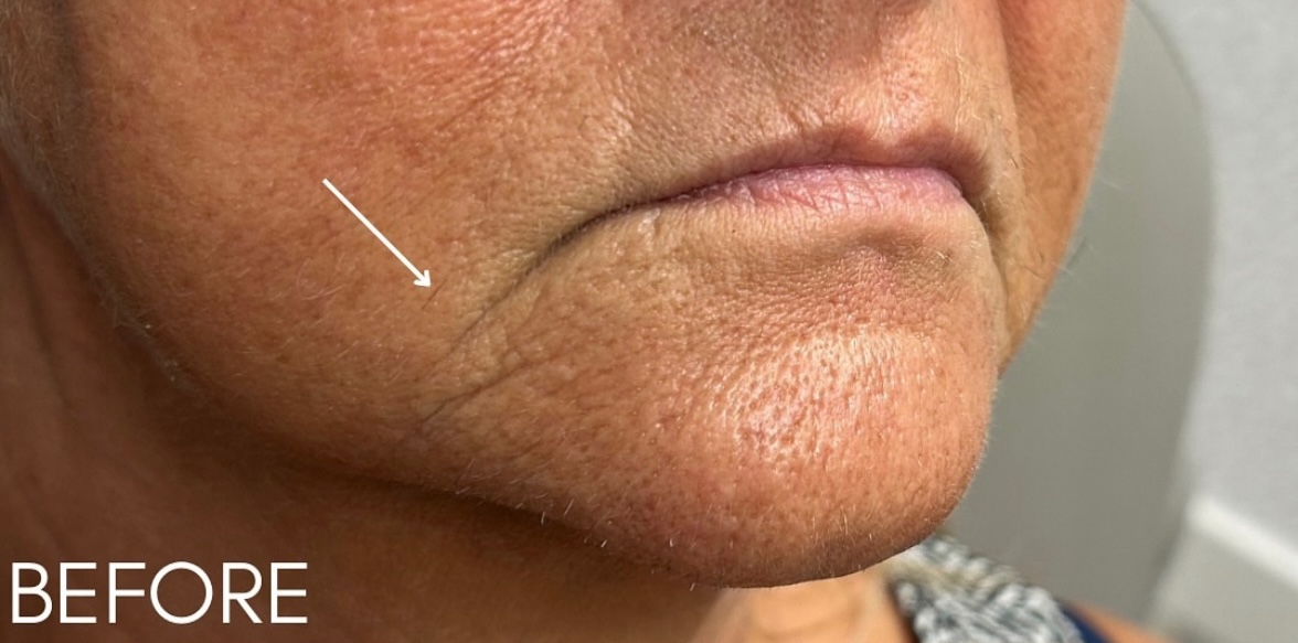 Lip Filler Before Patient 6