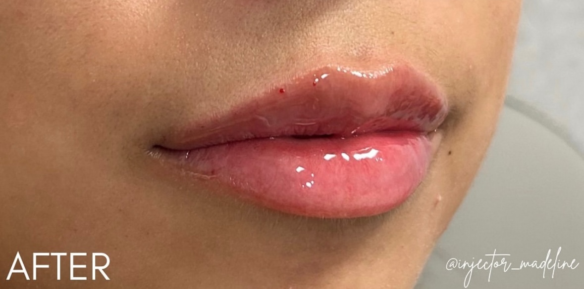 Lip Filler After Patient 8
