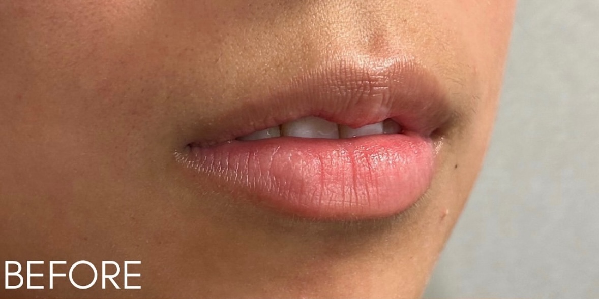 Lip Filler Before Patient 8