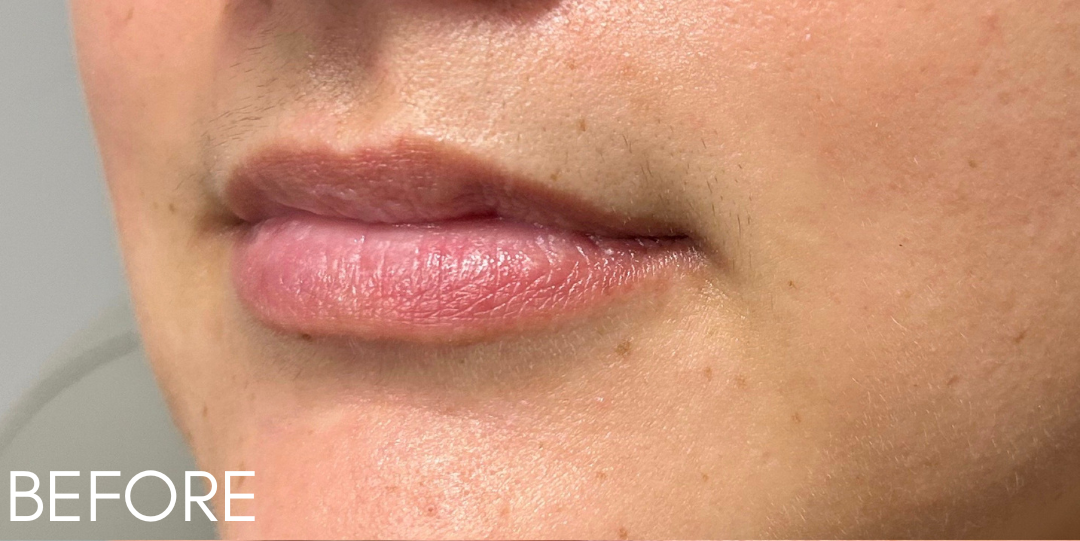 Lip Filler Before Patient 12