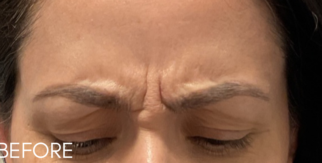 Botox® Cosmetic Before Patient 1