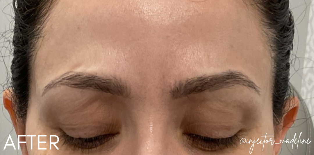 Botox® Cosmetic After Patient 1