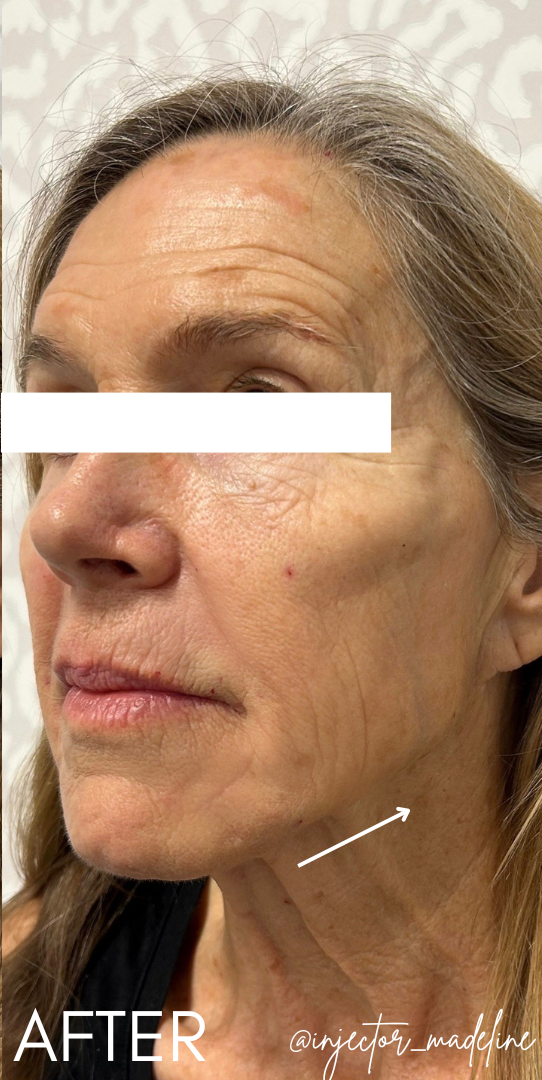 Jawline Filler After Patient 3