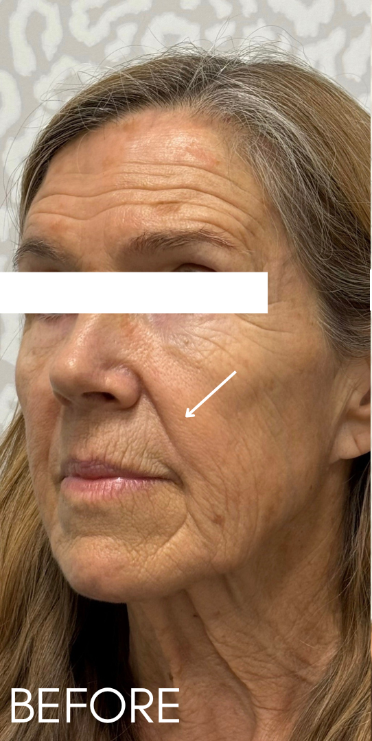 Jawline Filler Before Patient 3