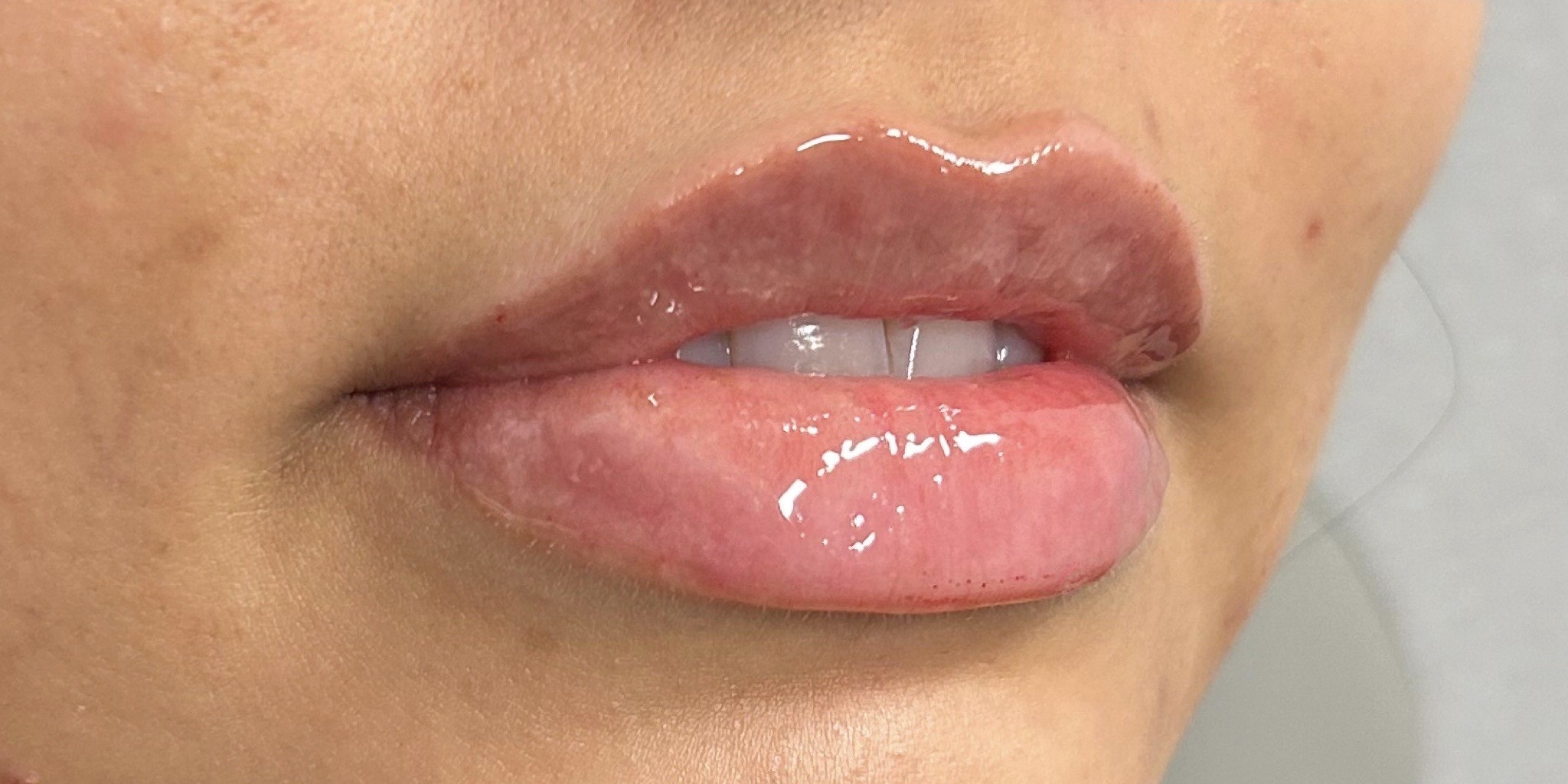 Lip Filler After Patient 6
