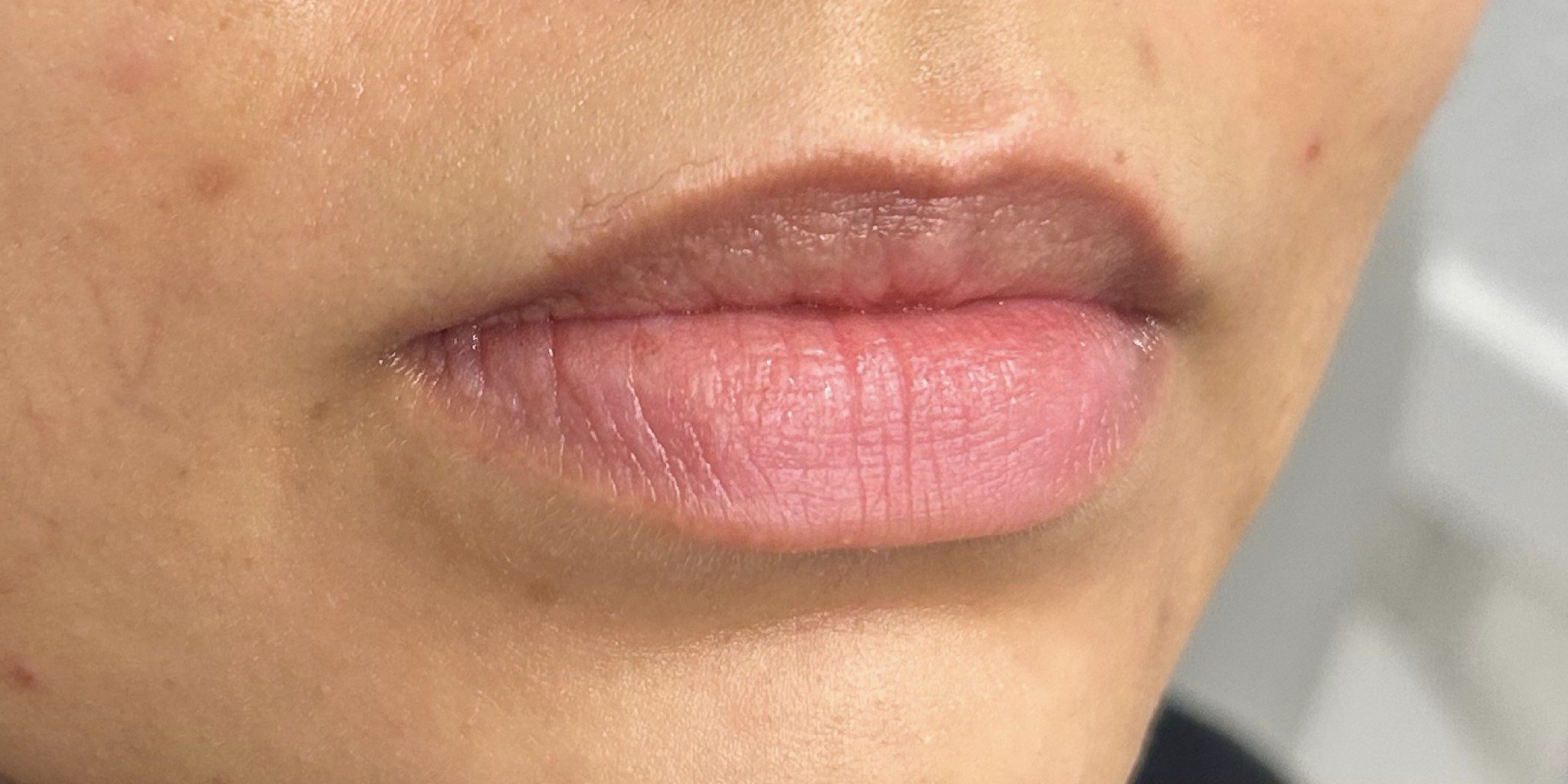Lip Filler Before Patient 6