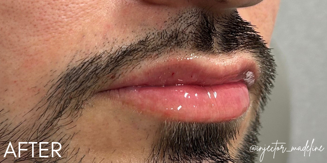 Lip Filler After Patient 10