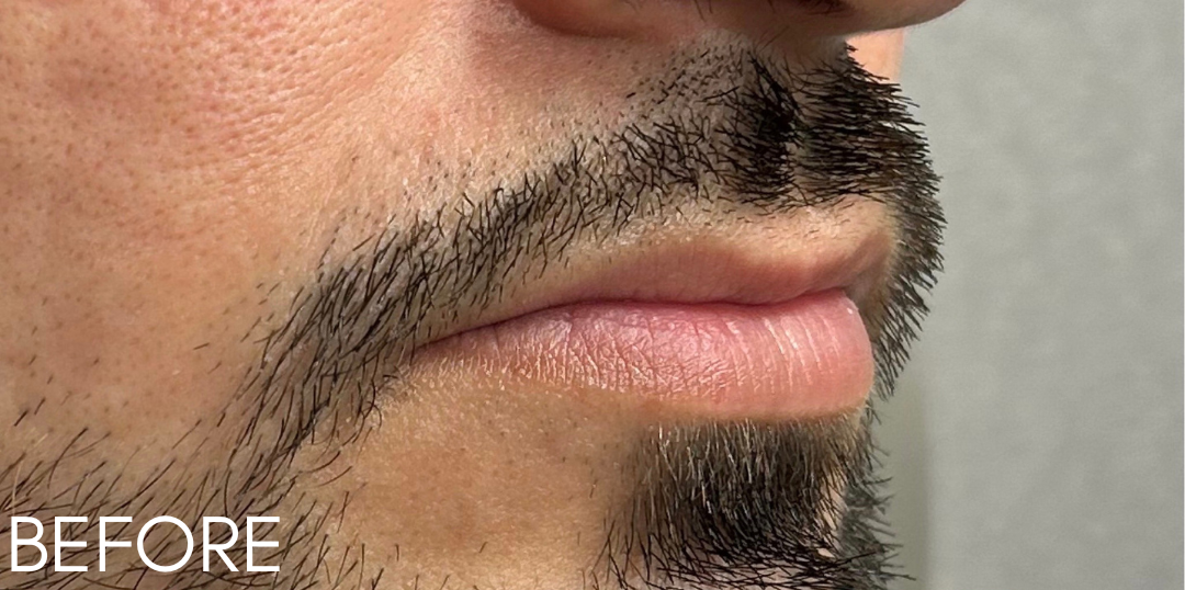 Lip Filler Before Patient 10