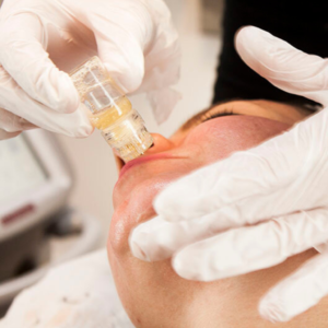 aquagold facial microneedling