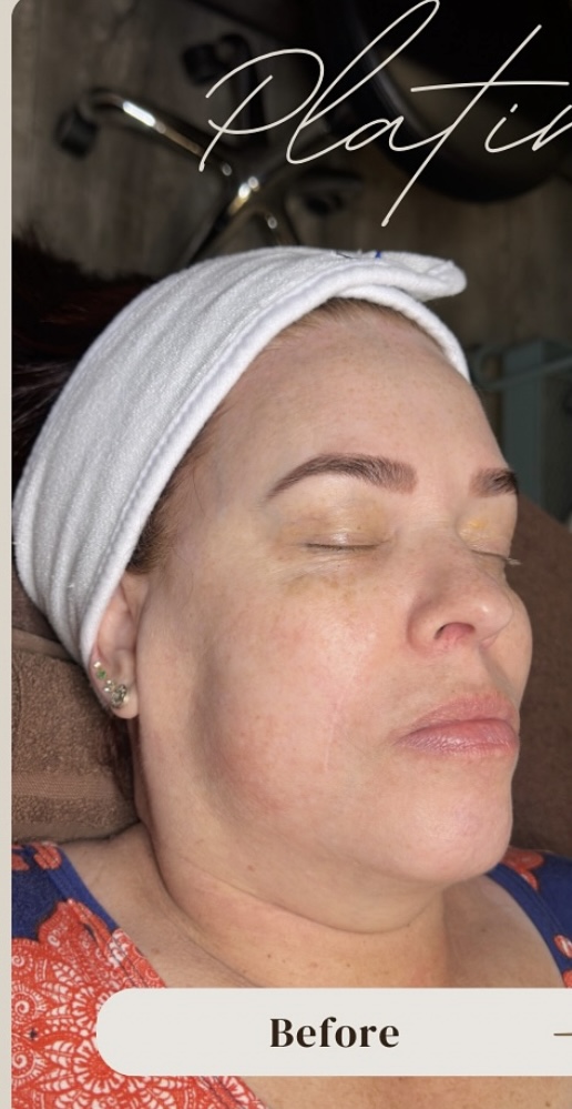 Facials Before Patient 4