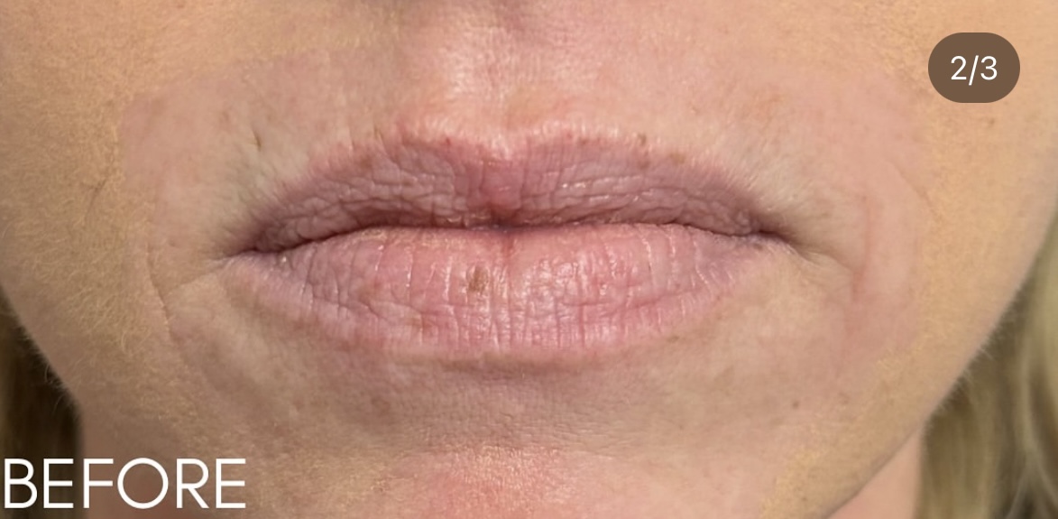 Lip Filler Before Patient 15