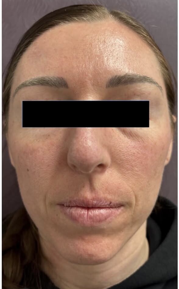 Facials Before Patient 5