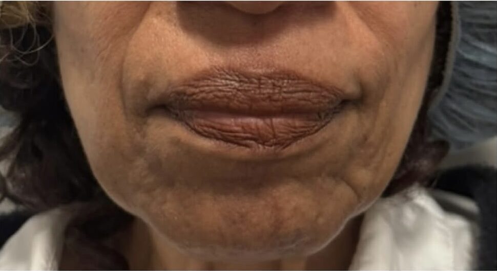 Injectables Before Patient 10