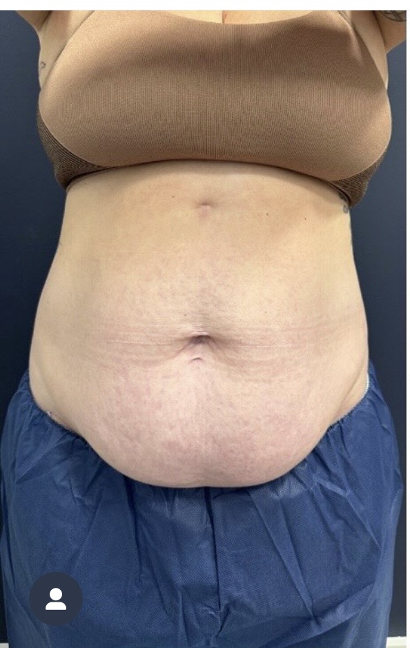 Medical Spa Before Patient 4