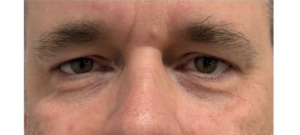 Injectables Before Patient 5