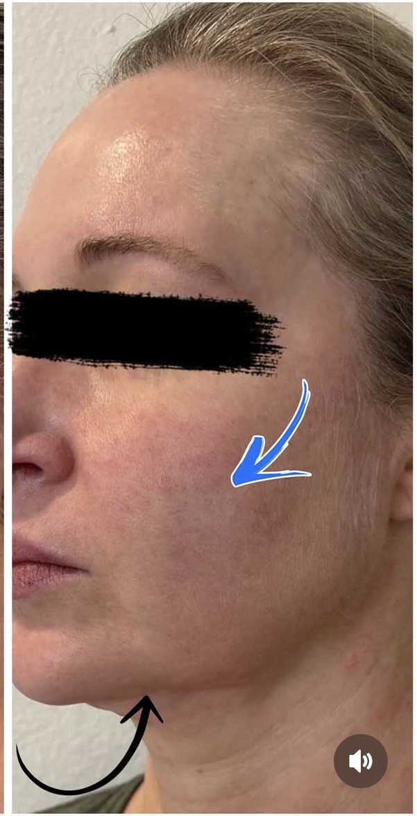 Medical Spa After Patient 3