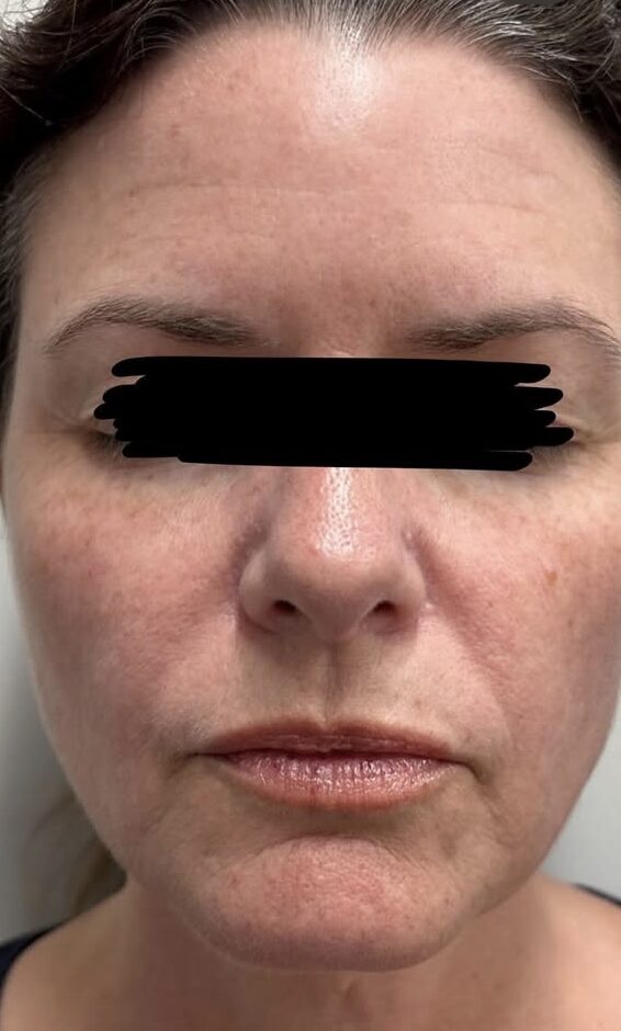 IPL Photo Rejuvenation After Patient 1