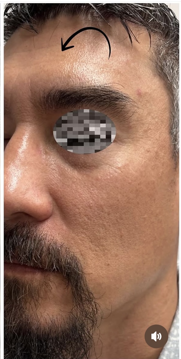 Vein Gogh Before Patient 5