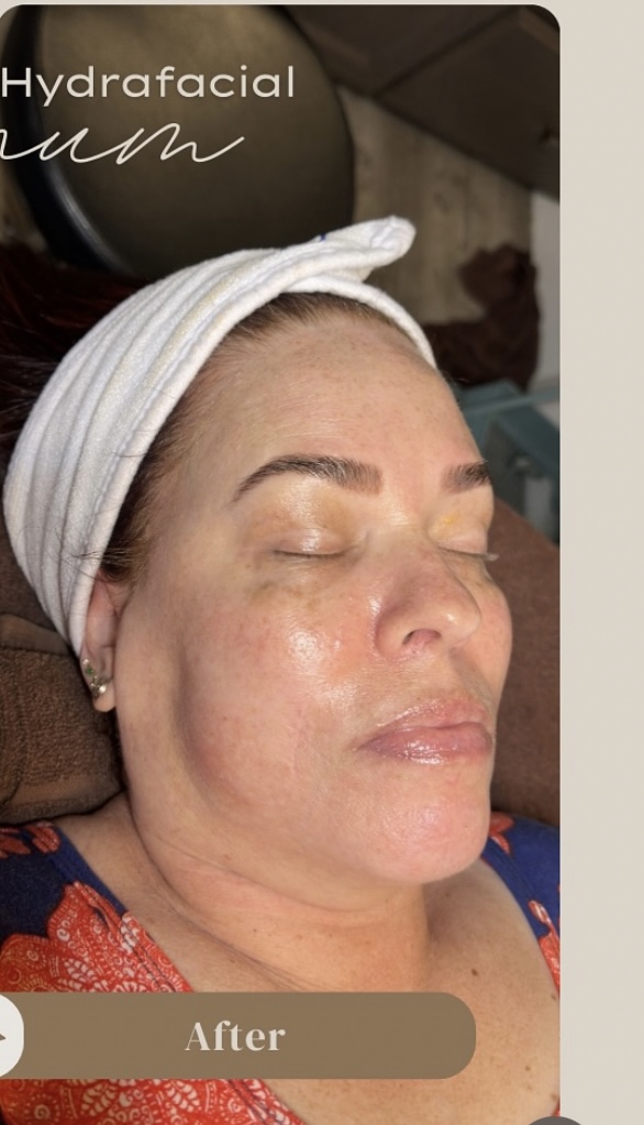 Facials After Patient 4