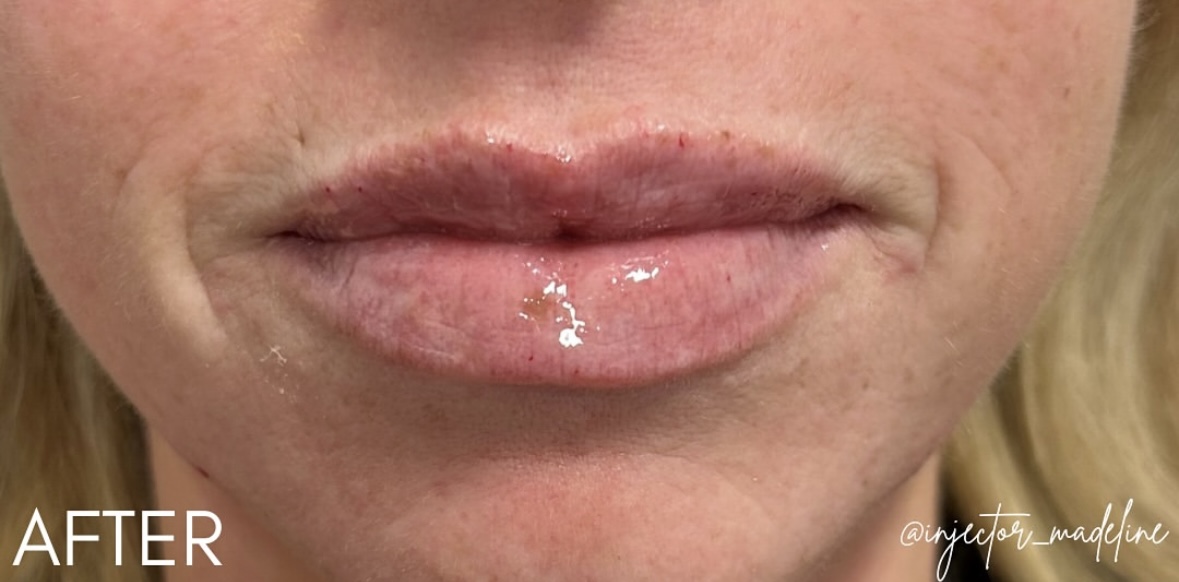 Lip Filler After Patient 15