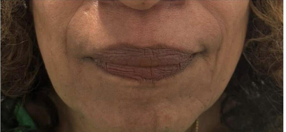 Injectables After Patient 10