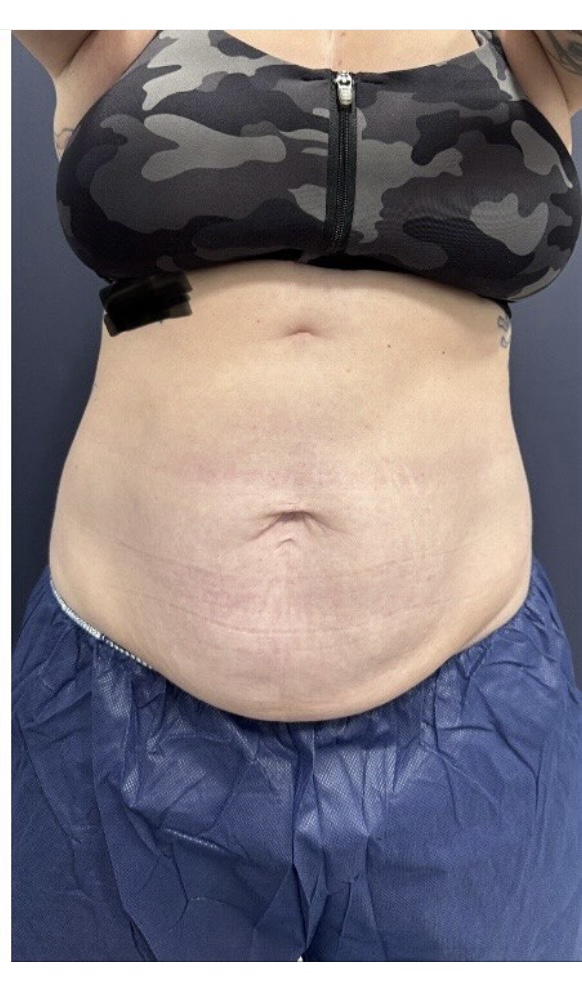 Medical Spa After Patient 4