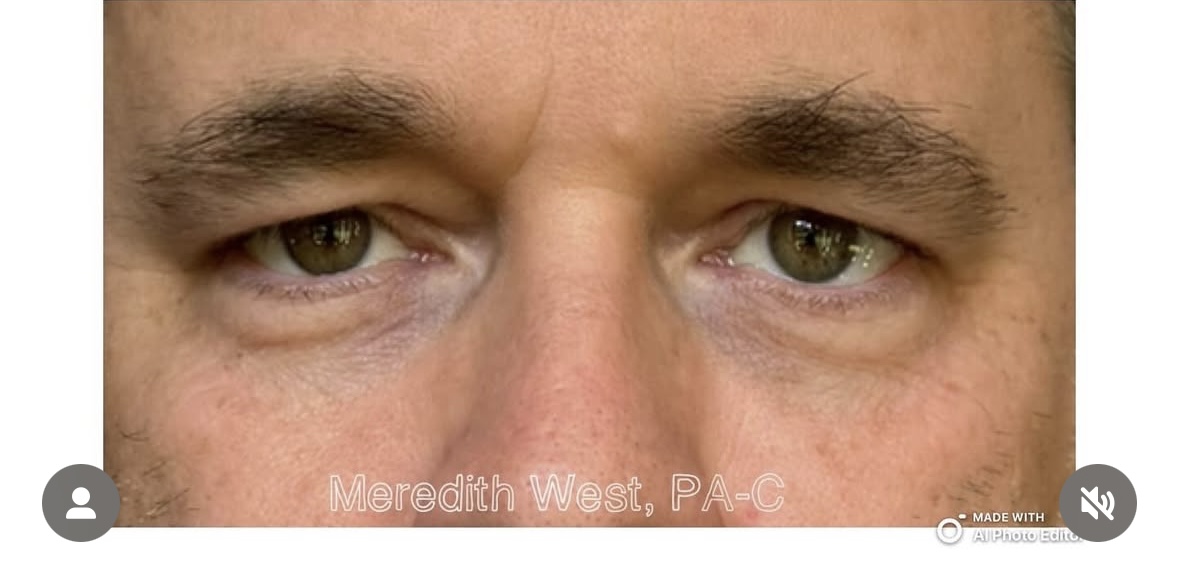 Injectables After Patient 5