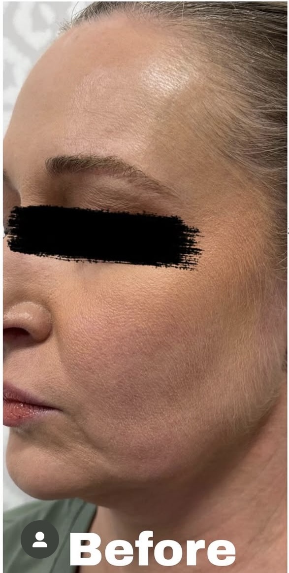 Medical Spa Before Patient 3