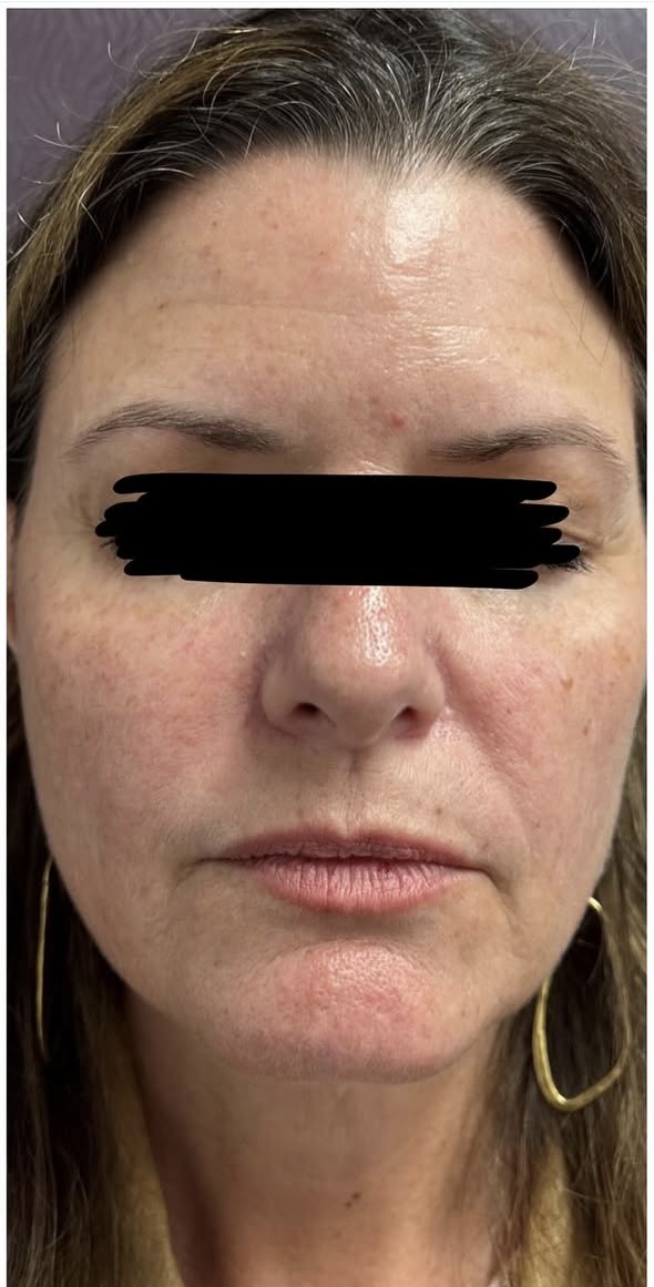 IPL Photo Rejuvenation Before Patient 1